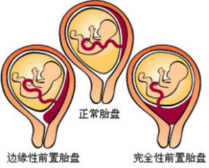 体外子宫探查试验是否必须进行？其目的是什么？